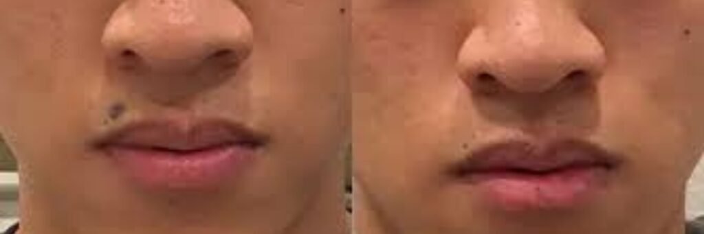 Laser Mole Removal Laser Mole Removal