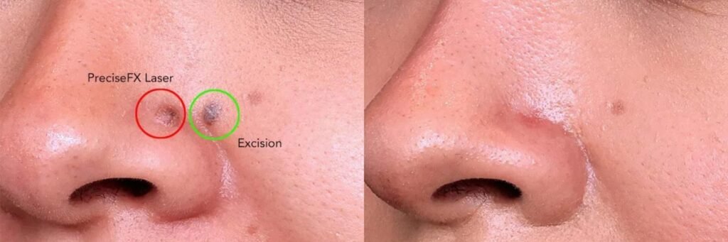 Laser Mole Removal Laser Mole Removal