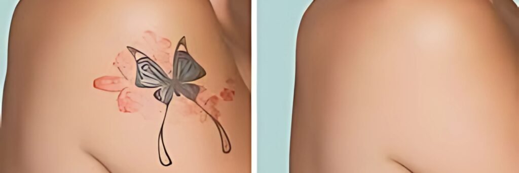 Tattoo Removal