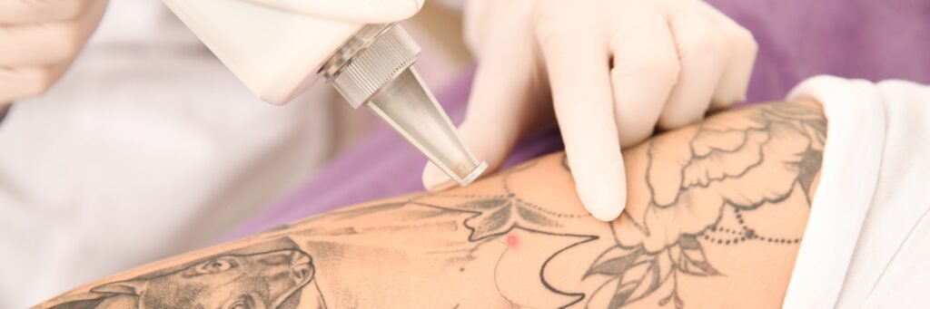 Tattoo Removal