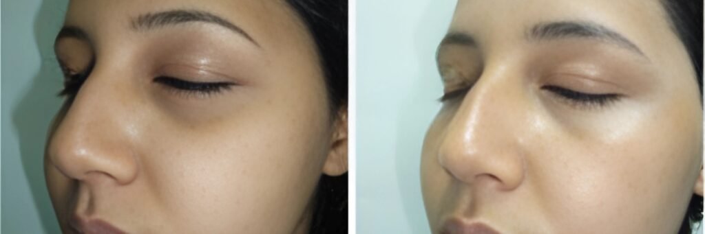 CO₂ Laser Treatment