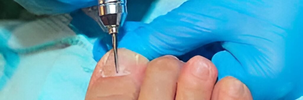 Nail Surgery Nail Surgery