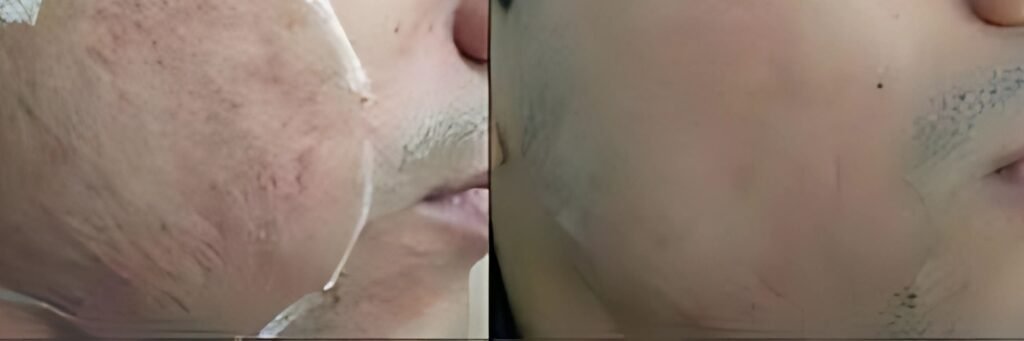 CO₂ Laser Treatment