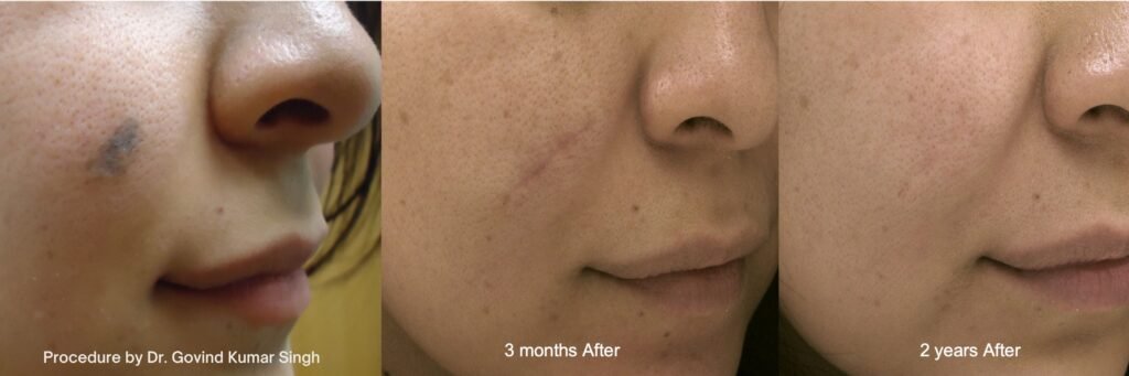 Laser Mole Removal Laser Mole Removal