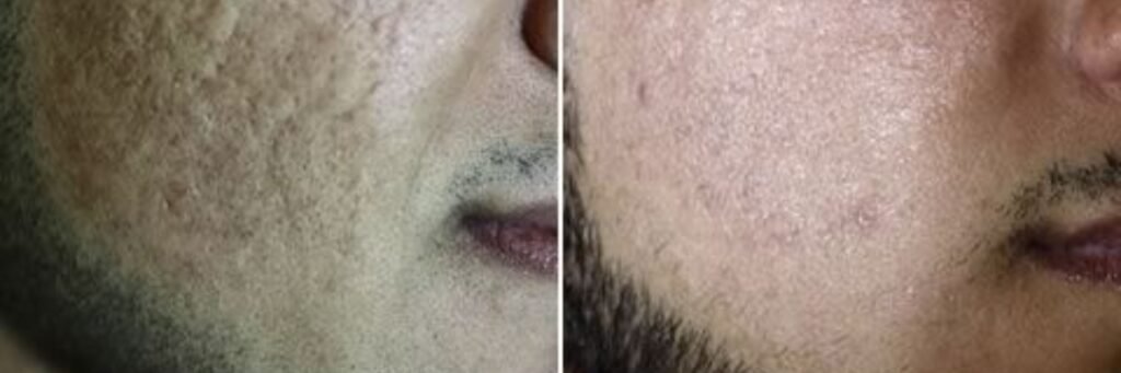 CO₂ Laser Treatment