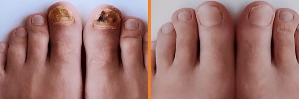 Nail Surgery Nail Surgery