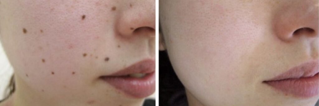 Laser Mole Removal Laser Mole Removal