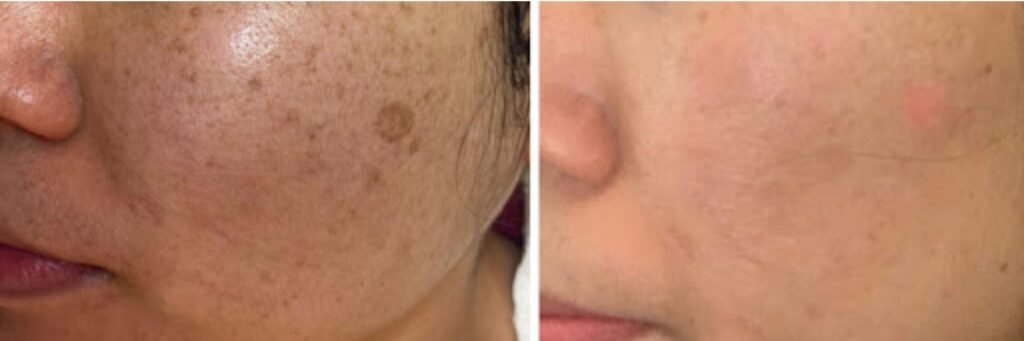 Q-Switched Laser Toning Q-Switched Laser Toning