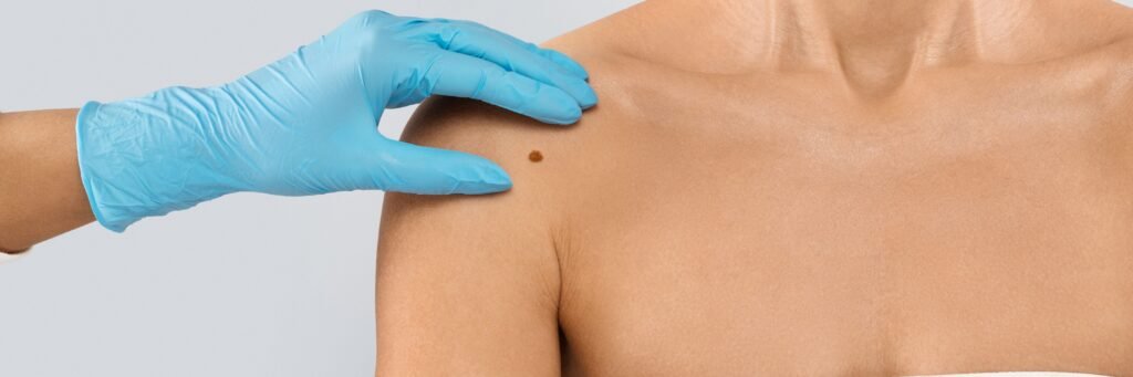 Mole Surgery