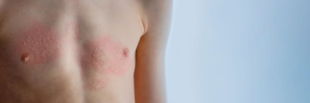 Skin Allergy & Urticaria Skin Allergy / Urticaria