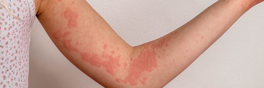 Skin Allergy & Urticaria Skin Allergy / Urticaria