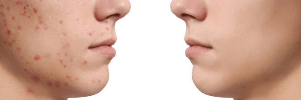 Q-Switched Laser Toning Q-Switched Laser Toning