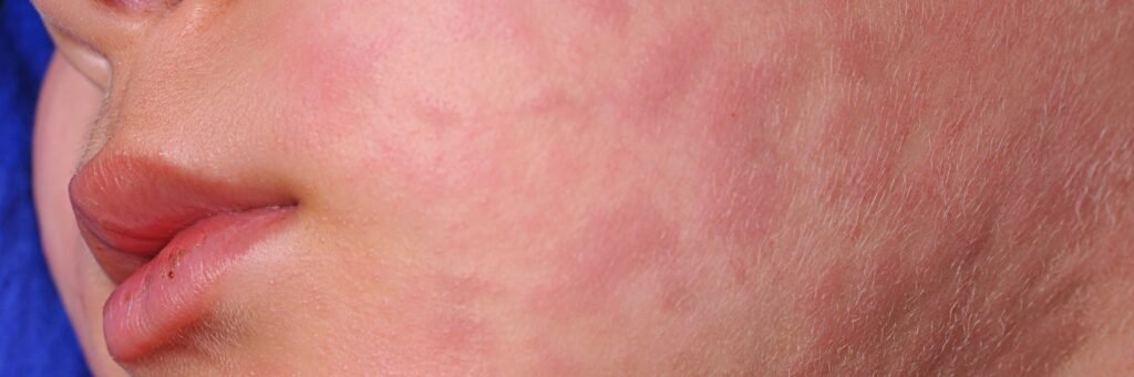 Skin Allergy & Urticaria Skin Allergy / Urticaria