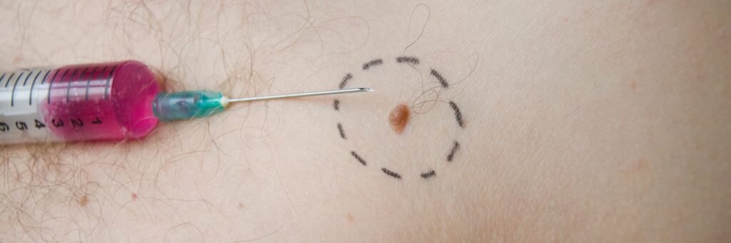 Birthmark Birth Mark