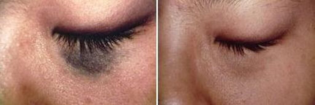 Birthmark Birth Mark