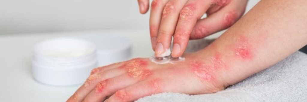 Eczema treatment