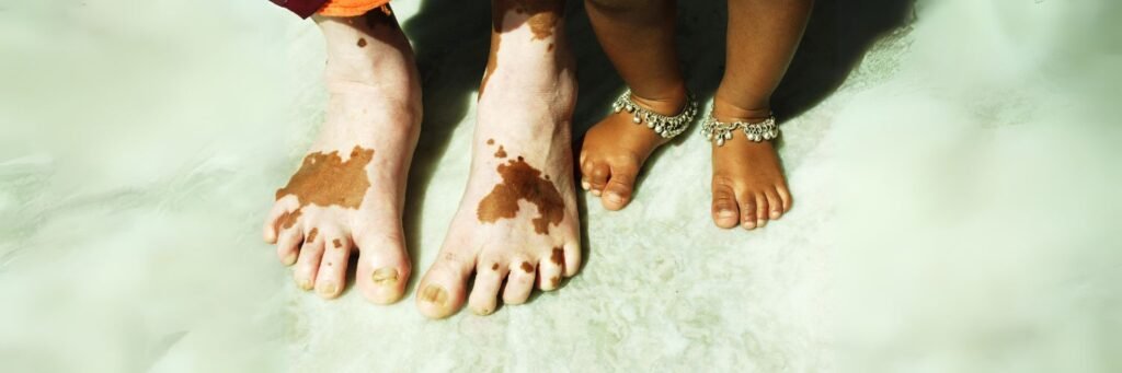 Vitiligo Vitiligo