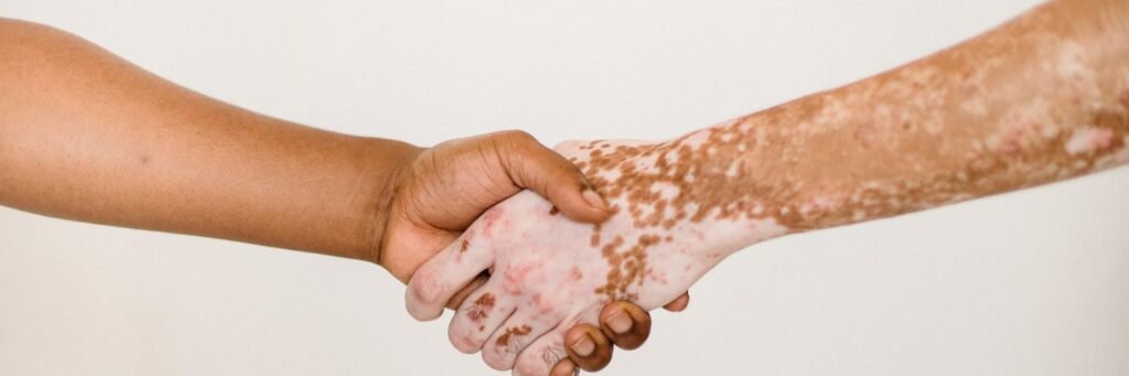 Vitiligo Vitiligo
